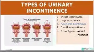 Types of Incontinence and Vital Treatments
