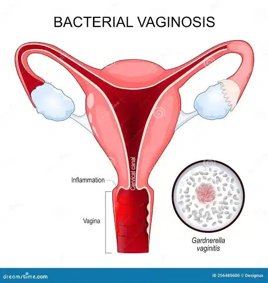 Can Nexplanon Cause Bacterial Vaginosis (BV)?